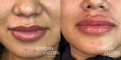 25-34 year old woman treated with Lip Fillers - Lip Flip with Smoothing Serum and Filler with RHA Redensity
