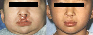 Bilateral Complete Cleft Lip  First and Second Stage Repairs - Infant born with severe complete bilateral cleft lip and palate.  The results of 2 stages of lip repair with complete closure of lip and then creation of columella part of nose with lip revision at age 5.  Will undergo cleft lip rhinoplasty and revisions later as a teen.