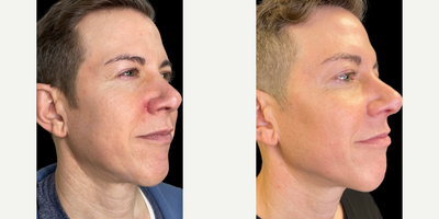 Woman treated with Sylfirm X - Woman treated with Sylfirm X