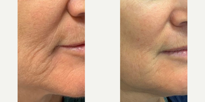 Woman treated with Sylfirm X - Woman treated with Sylfirm X