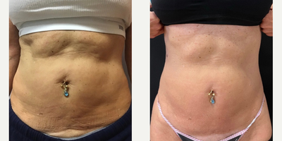 Woman treated with Sylfirm X - Woman treated with Sylfirm X