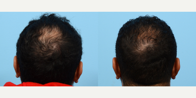 35-44 year old man treated with FUE Hair Transplant, Hair Transplant, Hair Loss Treatment, PRP for Hair Loss, Low-Level Laser Th - This patient wanted to restore his hairline and add density to the crown area. Dr. Wise performed an FUE hair transplant with 3,035 grafts and one treatment of PRP. 6 months post-op the patient is thrilled with his results and will continue to see growth up to the 1 year mark.