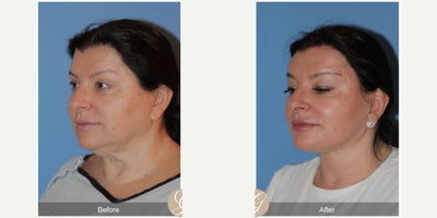 58 year old woman treated with Deep Plane Facelift, Neck Lift, Facelift, Brow Lift, MACS Facelift - 58 year old woman treated with Deep Plane Face and Neck Lift, Endoscopic Temporal Brow Lift, MAC