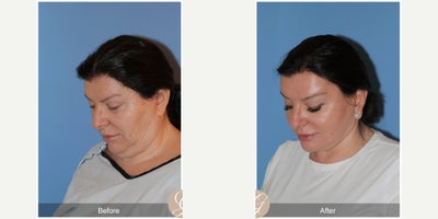 58 year old woman treated with Deep Plane Facelift, Neck Lift, Facelift, Brow Lift, MACS Facelift - 58 year old woman treated with Deep Plane Face and Neck Lift, Endoscopic Temporal Brow Lift, MAC