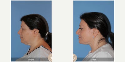 58 year old woman treated with Deep Plane Facelift, Neck Lift, Facelift, Brow Lift, MACS Facelift - 58 year old woman treated with Deep Plane Face and Neck Lift, Endoscopic Temporal Brow Lift, MAC