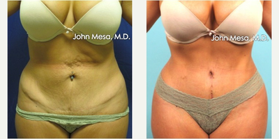 35-44 year old woman treated with Tummy Tuck Revision - 35-44 year old woman treated with Tummy Tuck Revision. Patient had a mini tummy tuck elsewhere. She underwent revision lipo-abdominoplasty