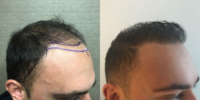 35-44 year old man treated with Hair Loss Treatment - Patient Age: 35-44Norwwod: 3VGrafts Number: 3000Method: Micro FUE /Extraction: Punch 0,75mm/Incision with special sapphire bladesPRP: One Session after Hair Transplant