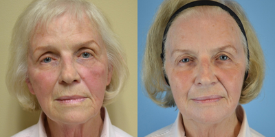 75 and up year old woman treated with ArteFill - 83 year old female received Artefill to multiple areas (crows feet, mid-face, temples and nasolabial folds) over the course of 3 visits in a 3 month period.