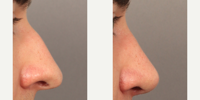 25-34 year old man treated with Rhinoplasty, Septoplasty, Alarplasty - Dr. Lexie Wang performed a Rhinoplasty, Septoplasty, and Alarplasty (nostril reduction). The patient is 4.5 months post-op.
