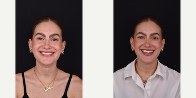 18-24 year old woman treated with Dental Bonding - 6 composite veneers corrected color and inclination of her teeth.
