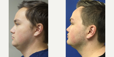 Man treated with Kybella - Kybella