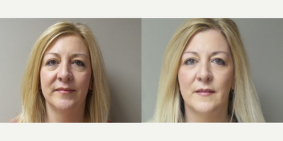 Woman treated with Bellafill - Bellafill
