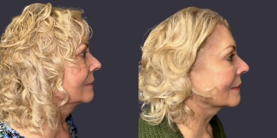 65-74 year old woman treated with ActiveFX, CO2 Laser, Eyelid Surgery, Laser Resurfacing - This 70 year had an upper and lower eyelid blepharoplasty surgery including CO2 laser resurfacing around the eyes. She is 5'6 tall and weighs 195 pounds. Her results are shown 6 months after surgery.