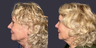 65-74 year old woman treated with ActiveFX, CO2 Laser, Eyelid Surgery, Laser Resurfacing - This 70 year had an upper and lower eyelid blepharoplasty surgery including CO2 laser resurfacing around the eyes. She is 5'6 tall and weighs 195 pounds. Her results are shown 6 months after surgery.