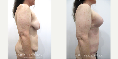 35-44 year old woman treated with Mommy Makeover - Mummy Makeover with combined Breast Implant Lift and Full Tummy Tuck