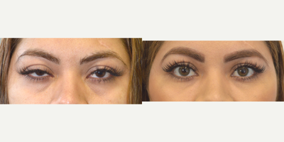 Upper eyelid ptosis (droopy eyelid) surgery in a young woman with asymmetric eyes. - 36 year old female, with eye asymmetry with asymmetric upper eyelid ptosis (droopy upper eyelids), underwent scar-less upper eyelid ptosis surgery using hidden inside eyelid approach, with quick recovery. Before and 2 months after eyelid ptosis repair photos are shown.