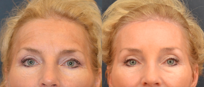 browlift - Trichophytic browlift