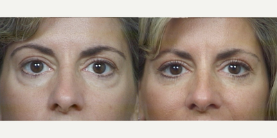 35-44 year old woman treated with Eyelid Surgery - 35 year old female with full appearing lower eyelids. A finding that was common in her family. Treated with Lower Lid Blepharoplasty (Eyelid Lift)