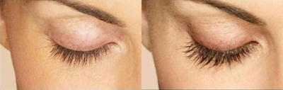 Latisse - Woman treated with Latisse