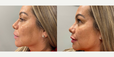 45-54 year old woman treated with Restylane Kysse - This patient turned to Dr. Wise to plump out her pout with Restylane Kysse, the longest lasting lip filler available. After photos were taken immediately following injections.
