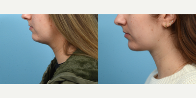 25-34 year old woman treated with Chin Surgery - Looking to define her jawline an improve the look of her double chin, this patient opted for submental liposuction with Dr. Wise. Two months post-op, she's thrilled with the outcome.