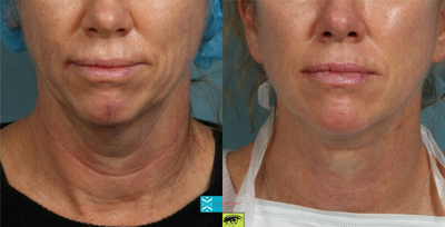 Woman treated with Nonsurgical Neck Lift - Woman treated with Nonsurgical Neck Lift