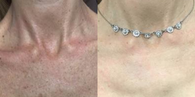 45-54 year old woman treated with BroadBand Light (BBL) - BBL treatment to improve complexion of chest