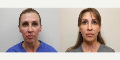 Woman treated with Sofwave - Photo provided courtesy of Sofwave, performed by Awaken Aesthetics