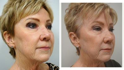 65-74 year old woman treated with Renuvion - Full face J Plasma (Renuvion) skin resurfacing with fat grafting and upper blepharoplasty