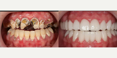25-34 year old woman treated with Tooth Repair - A full mouth rehabilitation with multiple extractions, dental implants, multiple root canal treatments, long-term custom laboratory provisionals, and a combination of all ceramic veneers and crowns. This patient suffered for many years with pain from rampant decay, infections, and an extremely displeasing smile. Also utilized Botox to reduce her jaw clenching and eliminate pain.