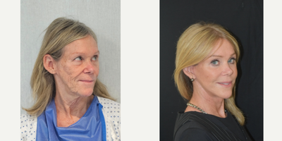 68 year old woman treated with vertical dual-plane facelift and deep necklift with corset platysmaplasty, facial fat transfer an - patient had tried to fight the signs of facial ageing solely with fillers over the years. Ended up with uneven contour, lumps and bumps, the fillers were very obvious in a bad way. I convinced her to remove her fillers and undergo a surgical facial rejuvenation.