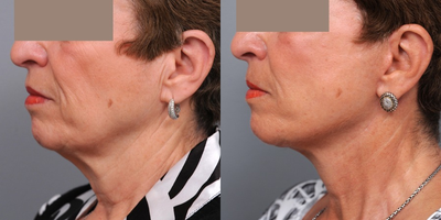 Lower Facelift Manhattan - After a consultation with Dr. Sterry, this patient chose a facelift in New York.  A full SMAS advancement was performed in an effort to give her a smooth and tension-free result with scars that would heal well.

The SMAS layer is a connective tissue and fatty layer that lies just under the skin. By completely elevating and advancing this tissue superiorly, Dr. Sterry is able to change the architecture of the face. This also allows him to close the skin wounds without any tension at all, leading to a much more natural appearance postoperatively. The skin does not look pulled, and the scars remain hidden.
