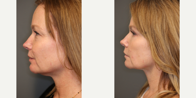 Upper and Lower Eyelid Surgery - Upper and lower eyelid surgery with laser.