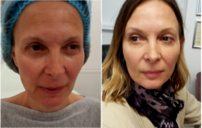 45-54 year old woman treated with Silhouette Soft - Silhouette soft