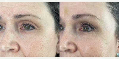 45-54 year old woman treated with Xeomin - Xeomin used on this 54 year-old patient to lessen appearance of glabeller, crows feet and forehead lines. Improvement shown one week after treatment.