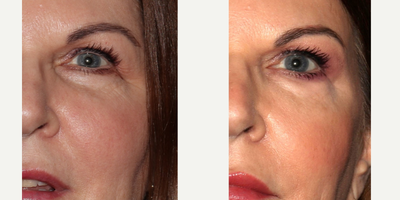 55-64 year old woman treated with Sofwave - This 64 year old client had Sofwave of the periorbital region. On this one month follow up it can be seen that the skin is tighter and smoother. Fine lines laterally have significantly diminished, and the skin under the tail of the brow is no longer hanging down due to the tightening effect there. Her results will continue to improve over the course of the next few months, and will be very long lasting. As she is in her 60's, repeat procedures every year or two will be recommended to maintain her results as we cannot stop the collagen loss due to aging.