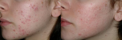 Acne and Isolaz - 23 year old 6 months after 5 isolaz sessions for acne
