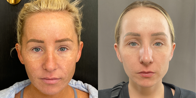 25-34 year old woman treated with Microneedling, Moxi, BroadBand Light (BBL) - A series of microneedling followed by Moxi & BBL to improve overall texture and tone