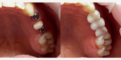 Women treated with Mini Dental Implants - We placed our patient's implants in 30 minutes. It took 4 days for the crowns to be made and the treatment to be completed.