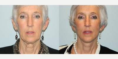 65-74 year old woman treated with Mini Lift - Before and 3 weeks after mini-facelift