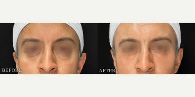 35-44 year old man treated with Skin Tightening - Endolift for the Under eye bags