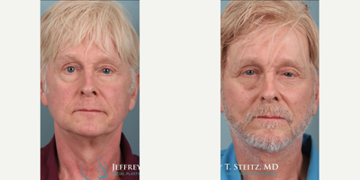Man treated with Facelift Revision - Man treated with Facelift Revision