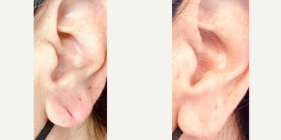 Patient treated with Earlobe Repair - Dont neglect your ears. We repaired our patients earlobes & this is the result 3 months after the procedure.