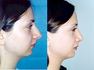 Rhinoplasty - Patient desired a smaller nose