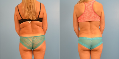 25-34 year old woman treated with Liposuction - Liposuction of back and flanks