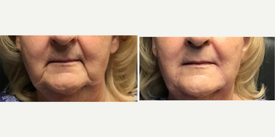 65-74 year old woman treated with RHA Collection Fillers - Patient was treated with RHA filler to correct deep folds and wrinkles in the nasolabial area, chin and lower face.