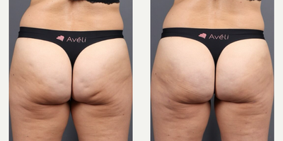 Woman treated with Aveli - Its National Cellulite Day and there is no better time to break up with your cellulite cream and get to know Avelithe one-time treatment that will actually give you fast, real results that last!Why choose Avli?.- Long-lasting results.- Minimally Invasive.- Little to no downtime.- Fast ResultsCheck out these awesome Avli Cellulite Treatment results.