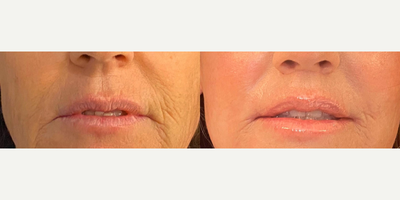 Woman treated with Lip Lift - Woman treated with Lip Lift with corner lift