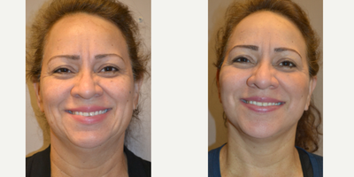 45-54 year old woman treated with Lifestyle Lift - Face and Neck Lift