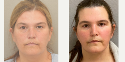 45-54 year old woman treated with Lower Facelift - 50 yo s/p lower facelift performed in our on site AAAA certified operating suite under local anesthesia with sedation